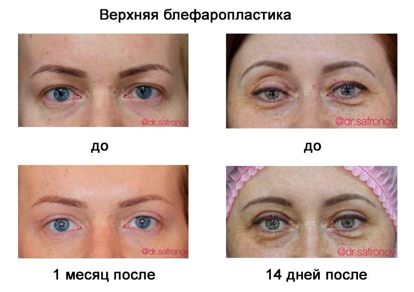 Блефаропластика: все, что вы хотели знать, но не у кого спросить