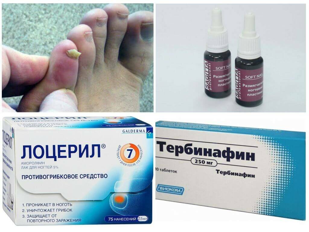 Чем лечить грибок ногтей на ногах: лучшие препараты и народные средства - медицинский портал doctor-365.net: симптомы и рекомендации по лечению различных заболеваний
