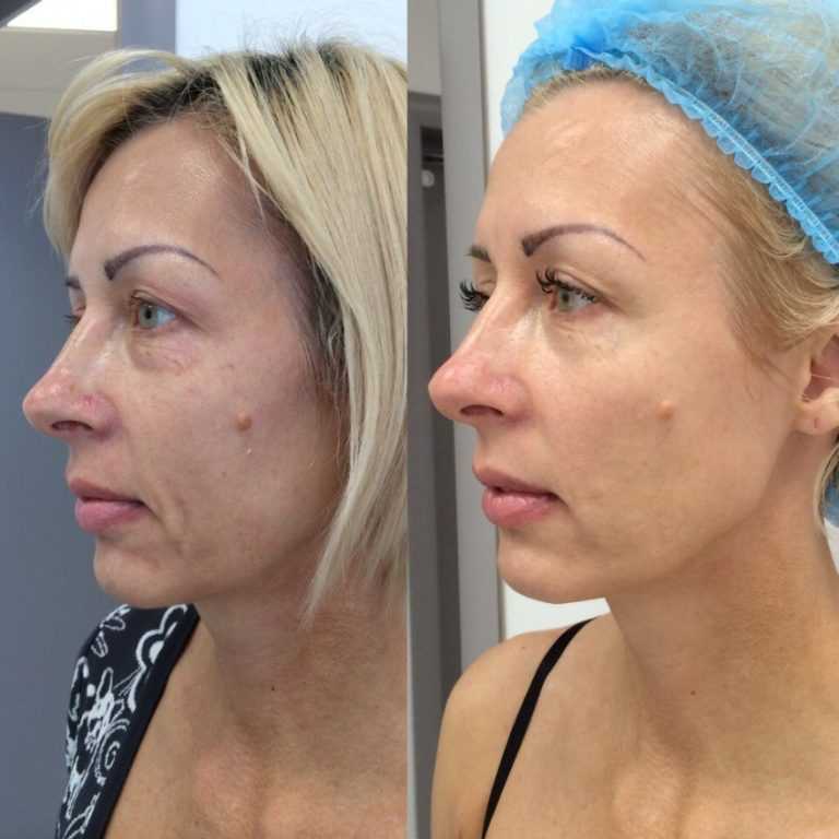 Что такое мезотерапия: описание процедуры