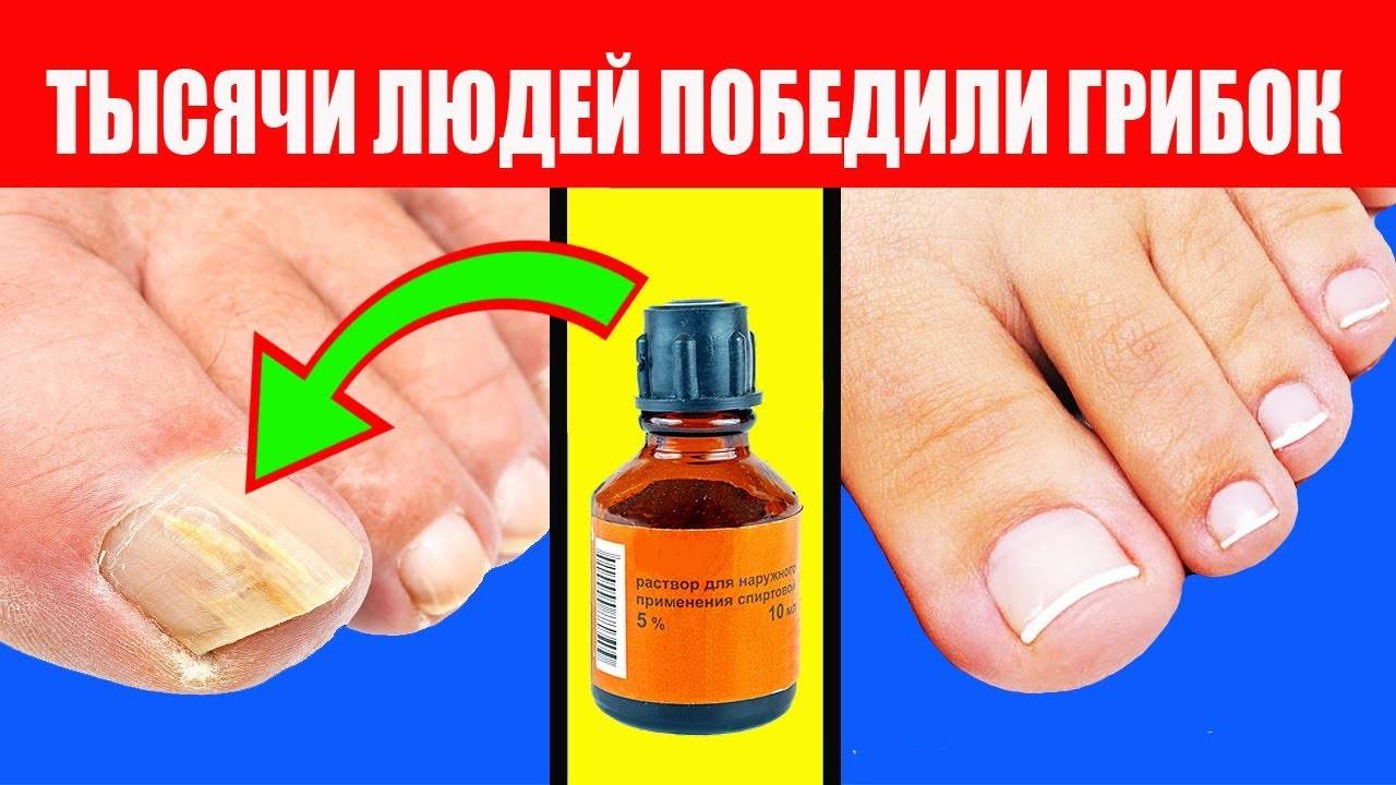 Лечение уксусом грибка ногтей: отзывы о лечении эссенцией