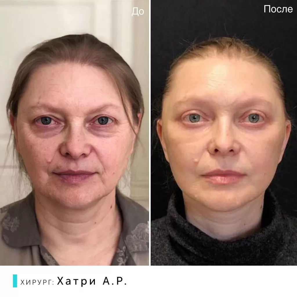 Круговая подтяжка лица: показания, виды, техники