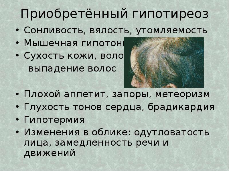 Выпадение волос из-за щитовидной железы