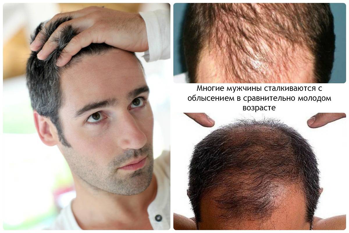 Облысение мужчин в молодом возрасте. причины, виды и что делать? - точка j