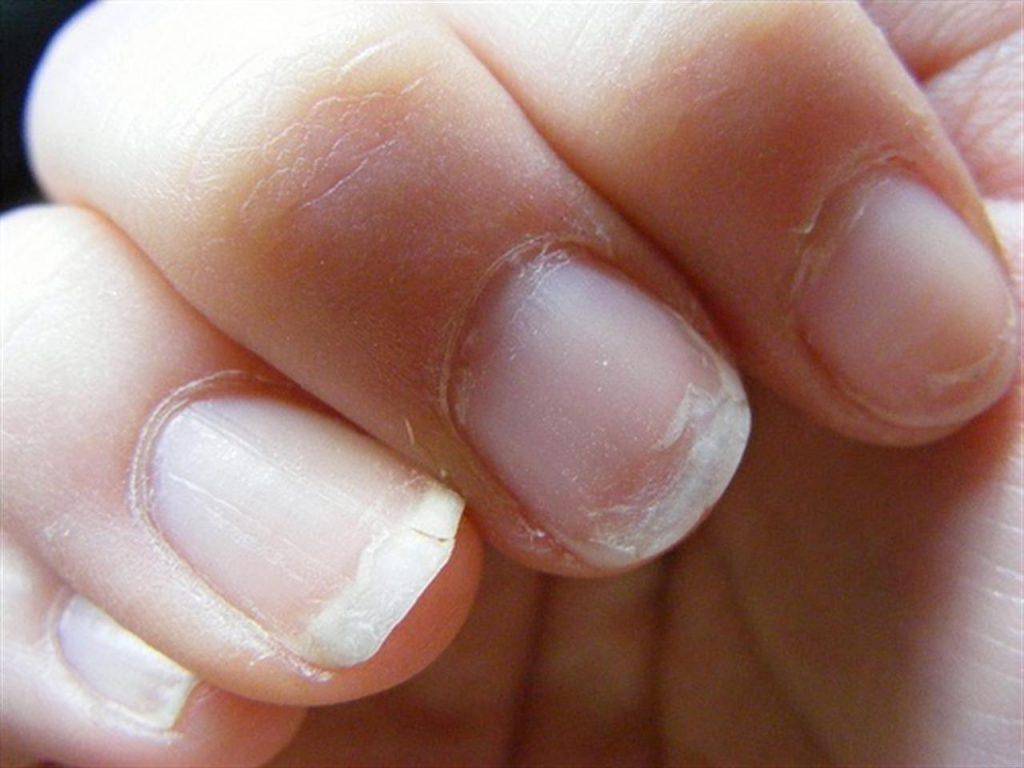 Ломкие, слоящиеся ногти: причины сухих, тонких ногтей, что делать, методы лечения | азбука здоровья