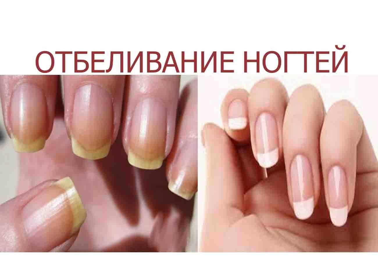 Как в домашних условиях быстро отбелить ногти на руках лимоном, лаком, в том числе после огорода, также использование отбеливающего карандаша с внутренней стороны