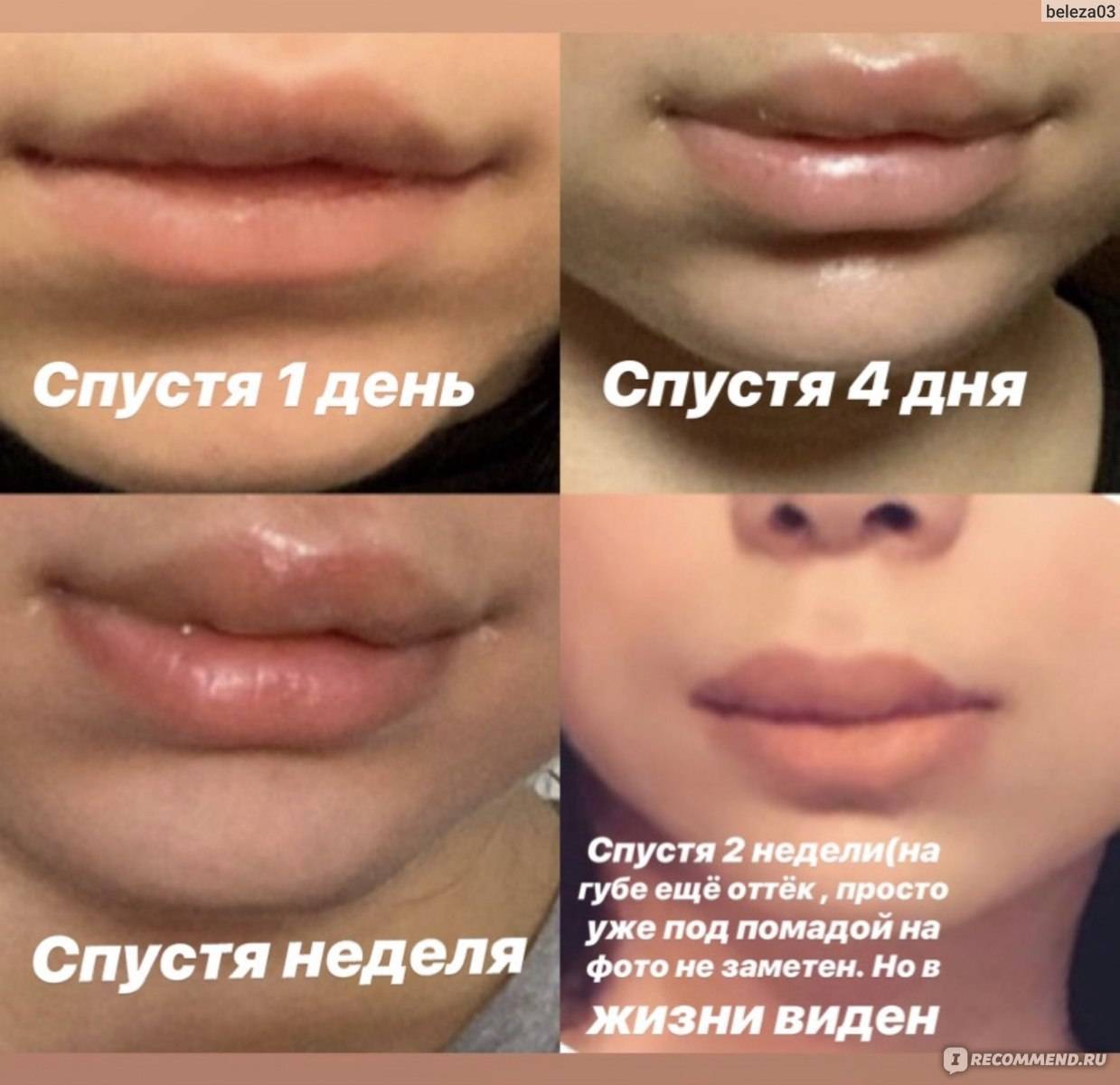 Рекомендации после контурной пластики губ