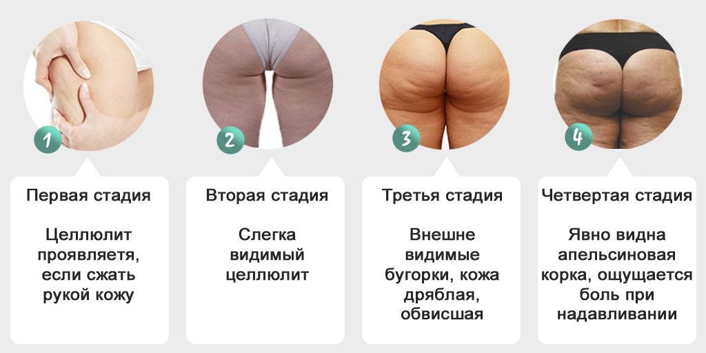Причины появления целлюлита у женщин