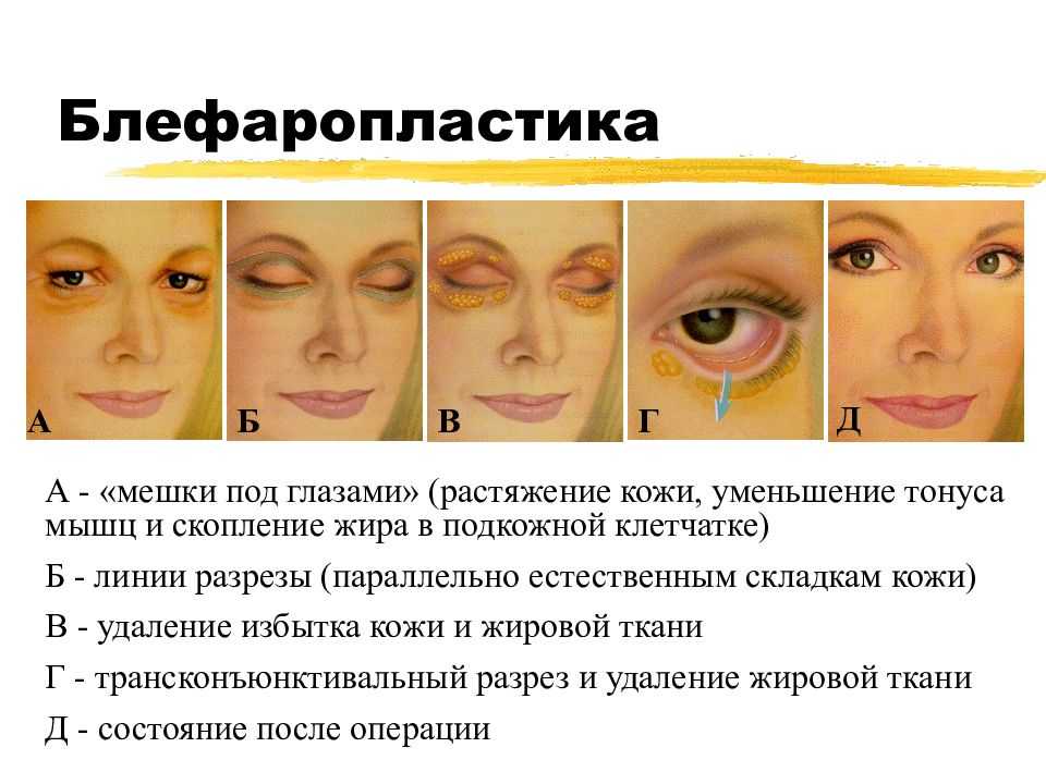 Как убрать синяк под глазом от удара: за 1 день в домашних условиях