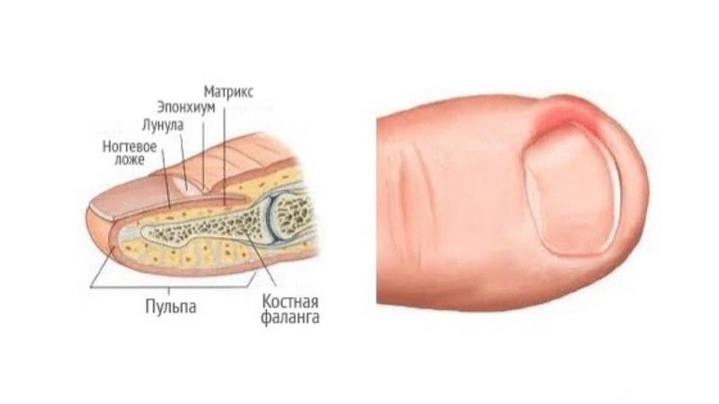 Травма ногтя руки — повреждение ногтевой пластины
