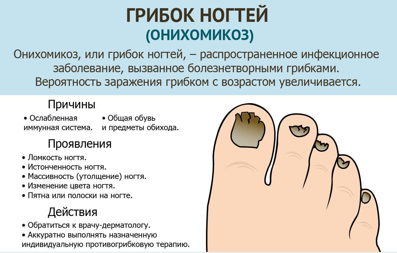 Как определить грибок на ногтях ног, рук, стопы - есть ли он?