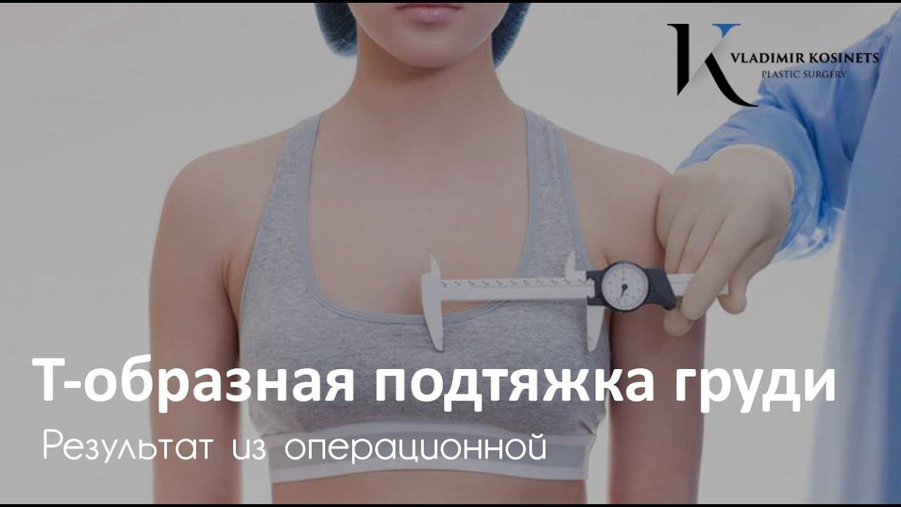 Подтяжка груди с имплантами: эндопротезирование, мастопексия, якорная, фото до и после | dlja-pohudenija.ru