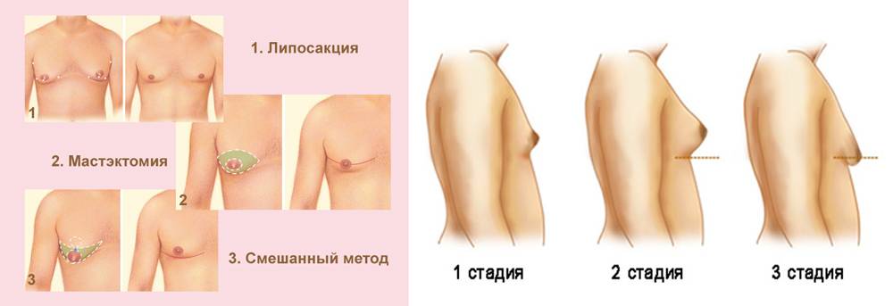 Как исправить форму соска – статьи клиники доктора нестеренко м.л.