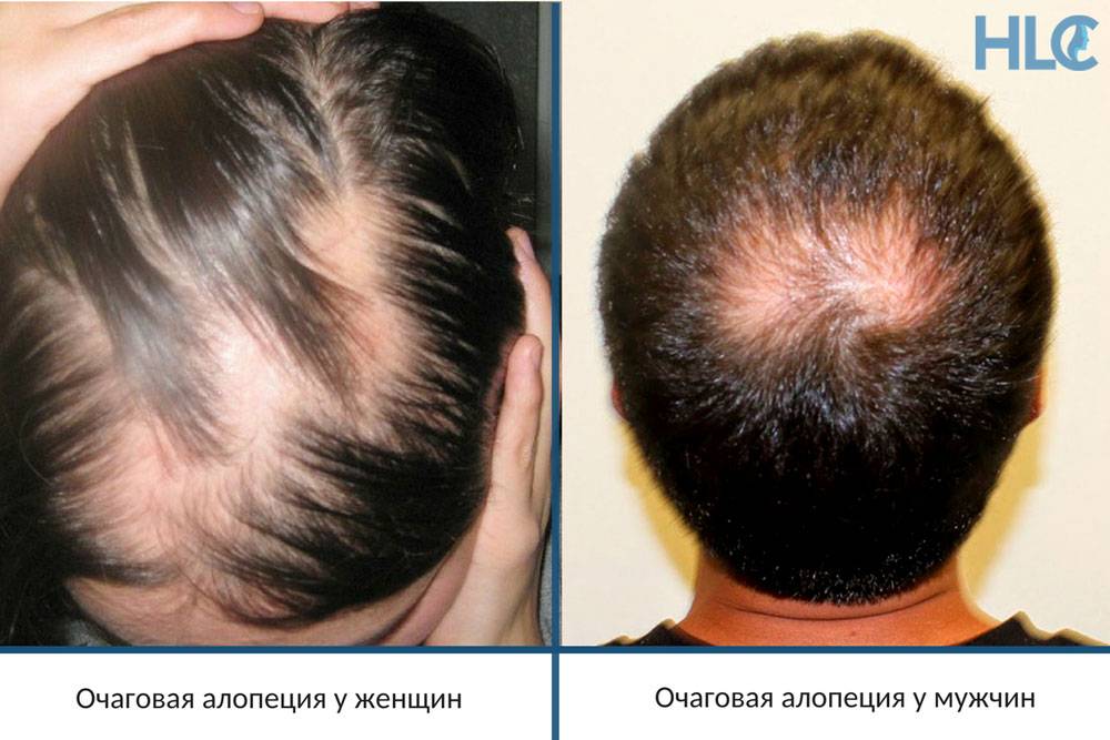 Что такое алопеция и как лечить эту болезнь на голове у женщин - причины облысения, как оно выглядит на фото и с чего начинается
