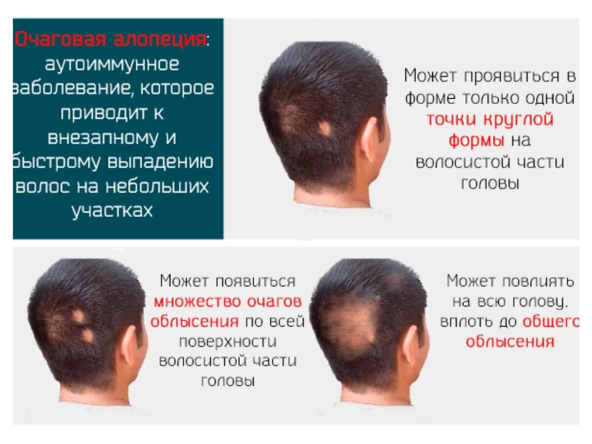 Лечение облысения у женщин в домашних условиях