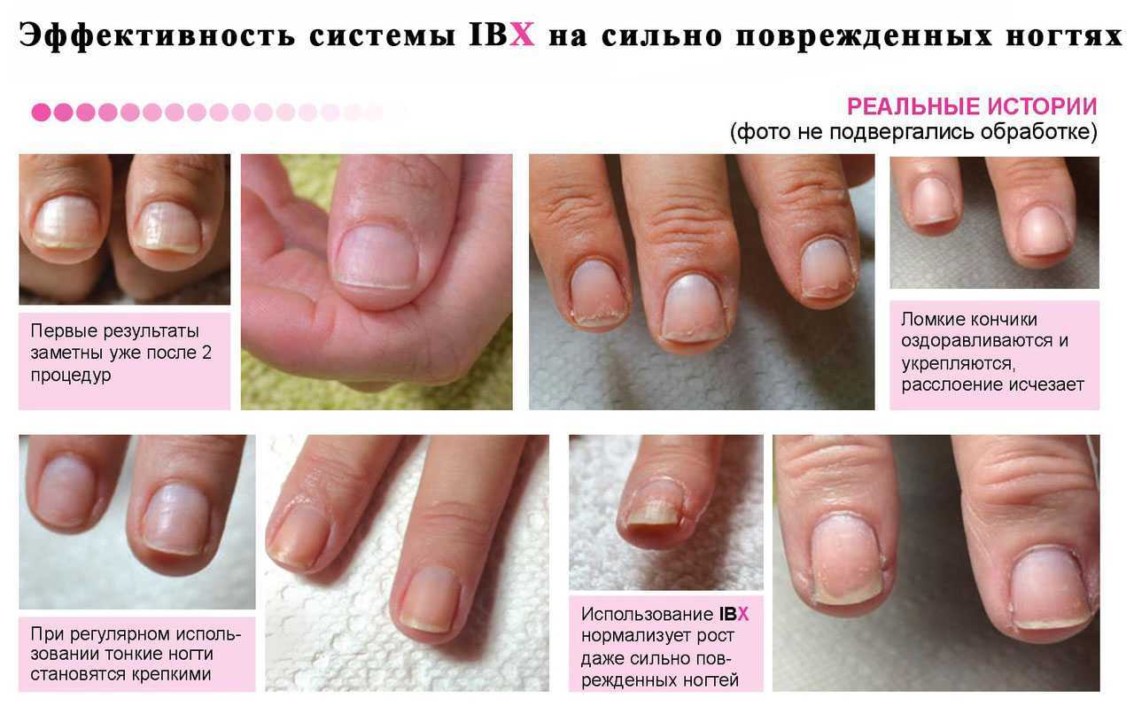 Как восстановить ногти после наращивания: способы, средства  
