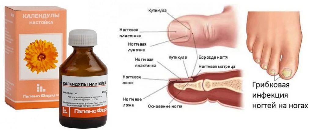 Онихомикоз ногтей: фото, лечение недорогими но эффективными препаратами