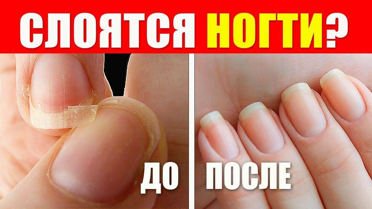 Если у вас слоятся ногти: что делать и как их лечить?