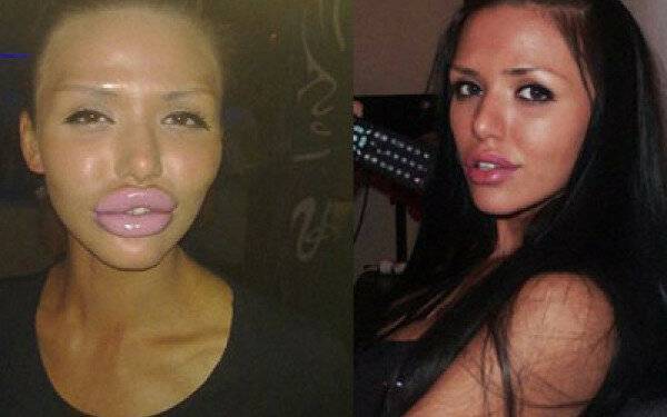 Чем качают губы: показания и противопоказания к процедуре