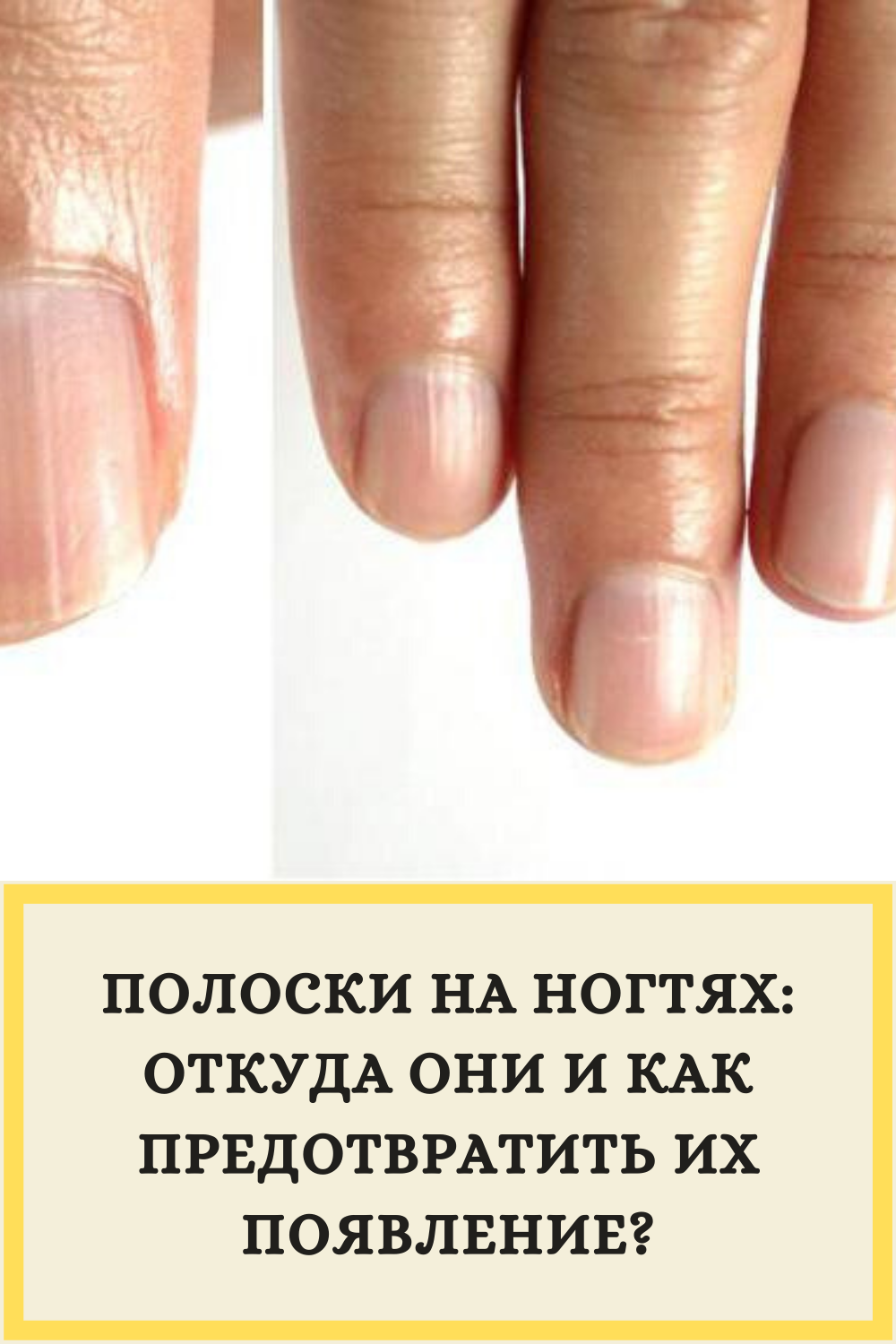 Белые полосы и пятна на ногтях – причины, диагностика и лечение