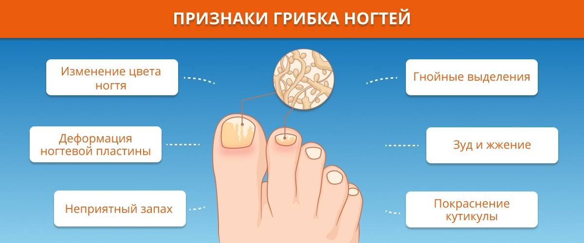 Онихомикоз (грибок ногтей) — основные методы лечения и профилактики
