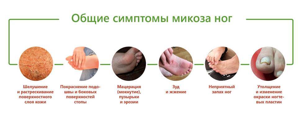 Начальная стадия грибка ногтей на руках и ногах: симптомы (фото) и лечение