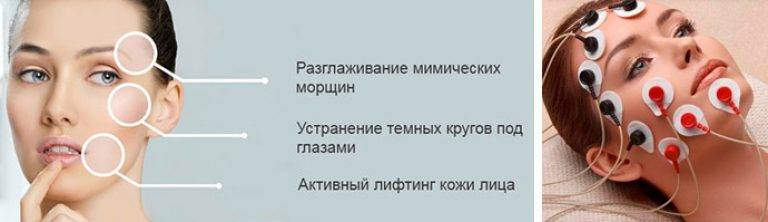 Миостимуляция: процедура, пришедшая из медицины