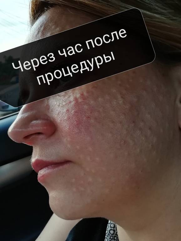 Сколько дней держатся папулы после биоревитализации, как ускорить процесс рассасывания | vetgospital31.ru