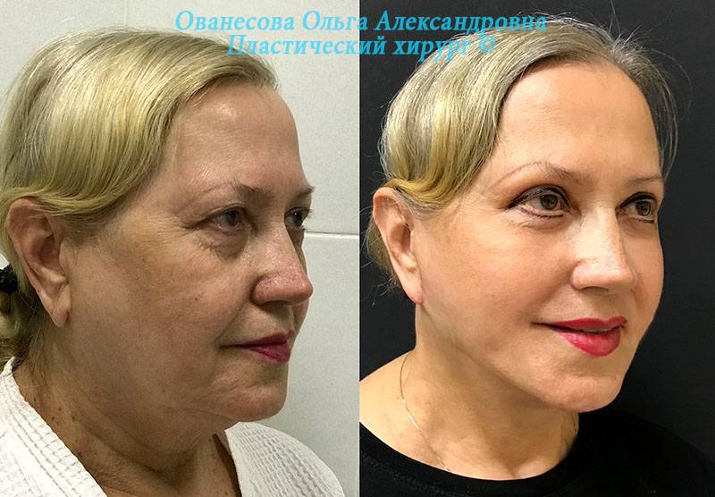 Круговая подтяжка лица - виды, обзор операции, отзывы + фото до и после