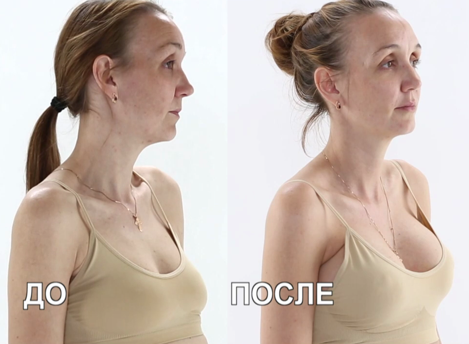 Тейпирование груди – безоперационная подтяжка груди тейпами