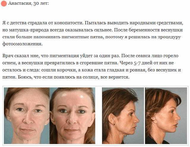 Фотоомоложение лица: плюсы и минусы