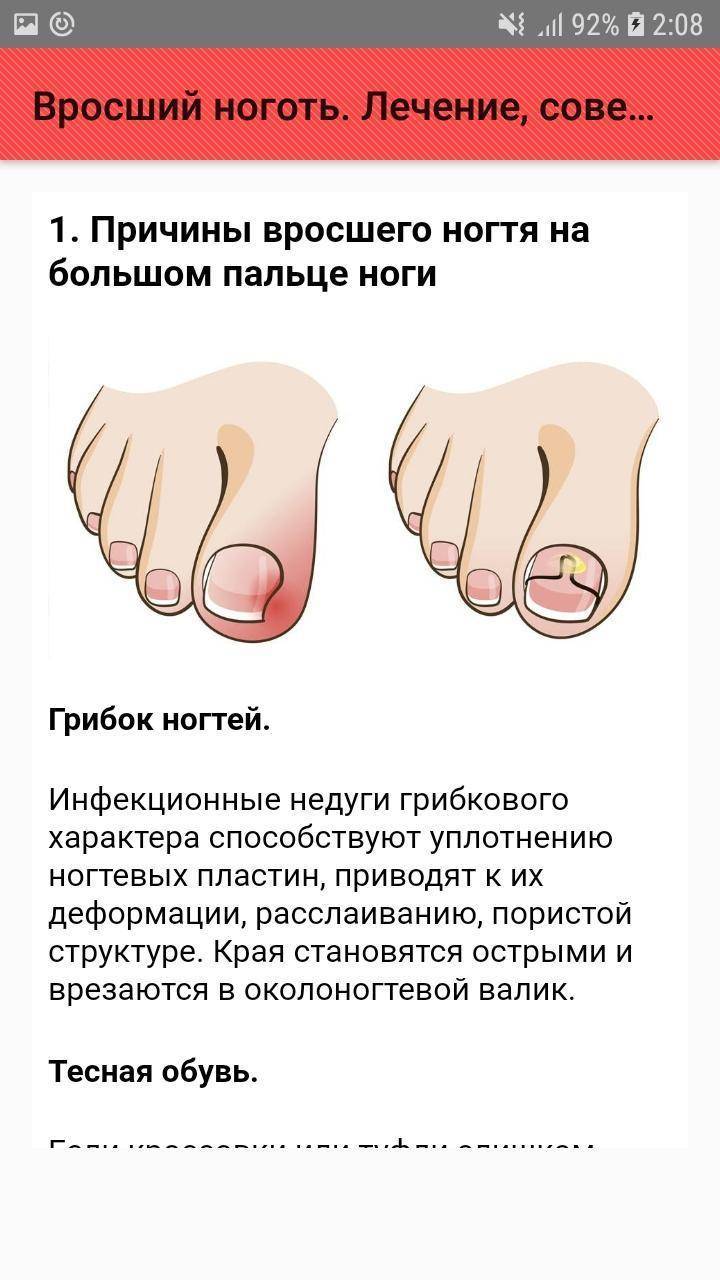 Как быстро размягчить ногти на ногах?