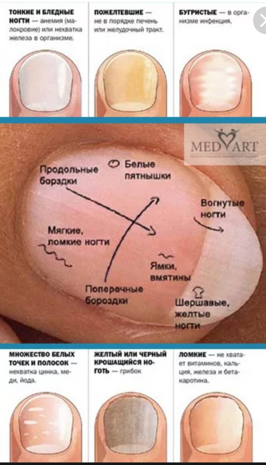 На ногтях продольные борозды о чем говорят. Определить болезнь по ногтям. Болезни по состоянию ногтевой пластины. Заболевания по ногтям рук.
