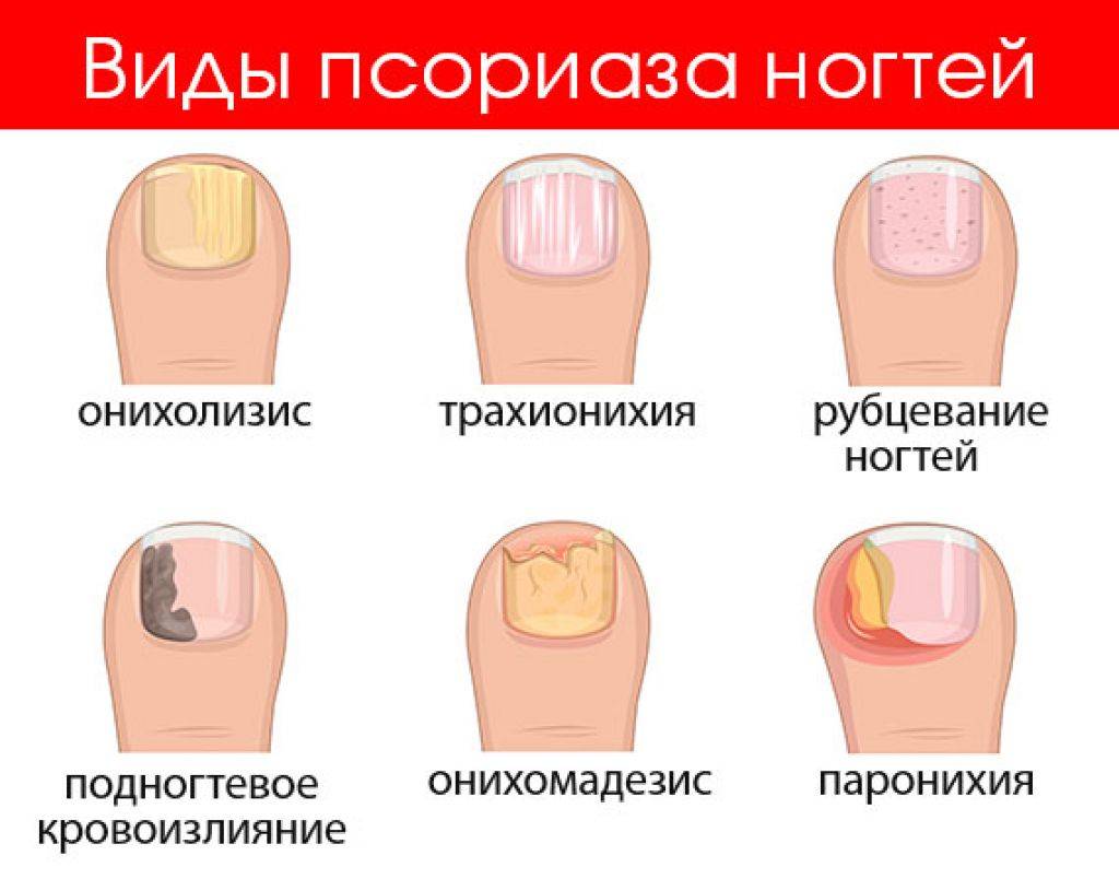 Почему слоятся ногти причины лечение. болезни ногтей на ногах описание и фото. причины, проявления, методы лечения , профилактика заболеваний ногтей на ногах. болезни ногтей на ногах: причины, симптомы, традиционное и народное лечение