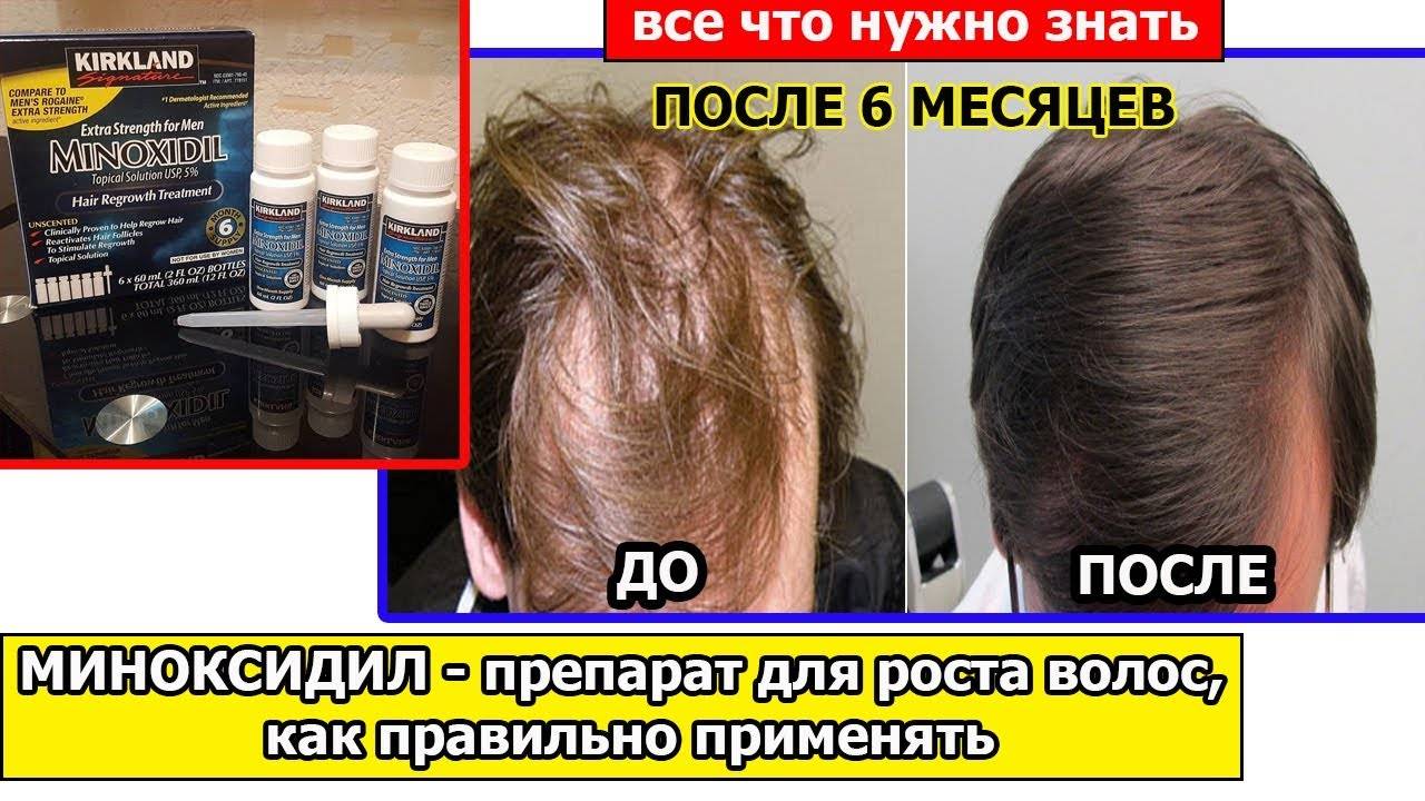 Девочки, кто пользовался миноксидилом и аналогами для лечения выпадения волос??? - страна мам