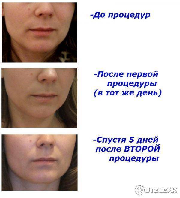 Rf-лифтинг лица: проведение процедуры, плюсы и минусы