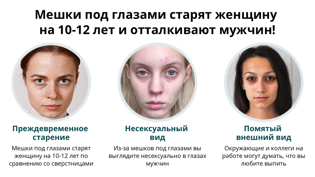 Синяки под глазами: причины у женщин и мужчин, отчего у молодых девушек появляется проблема, лечение, что делать если недуг не проходит