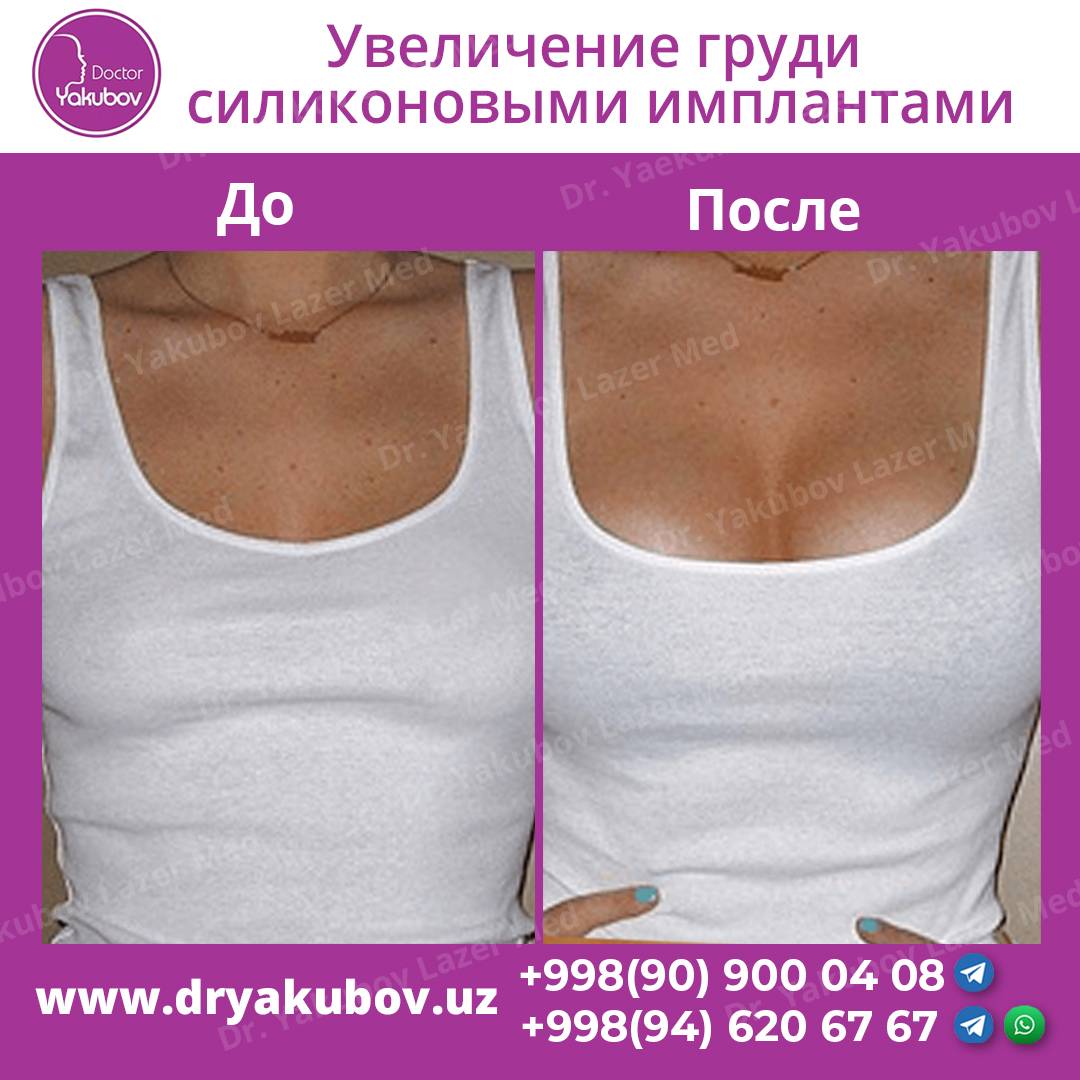 Какие грудные импланты самые лучшие: виды и фото