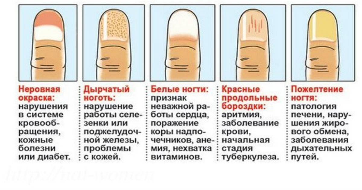 Расслоение ногтей