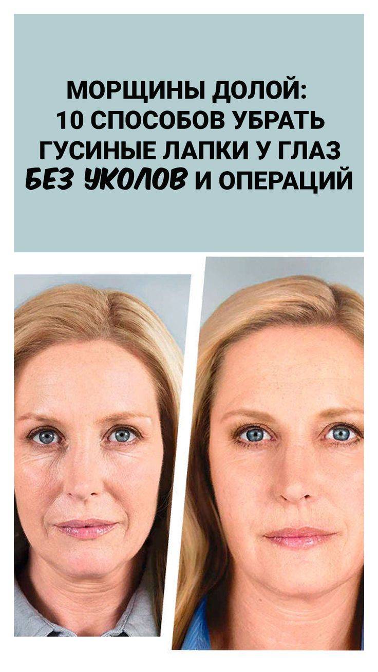 Эффективные способы убрать морщины вокруг глаз