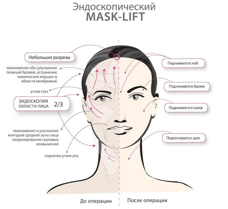 Эндоскопическая подтяжка лица - что это, как делается, чего ожидать и противопоказания + отзывы и фото до и после