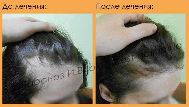 Что делать, если сильно выпадают волосы после родов: причины и лечение