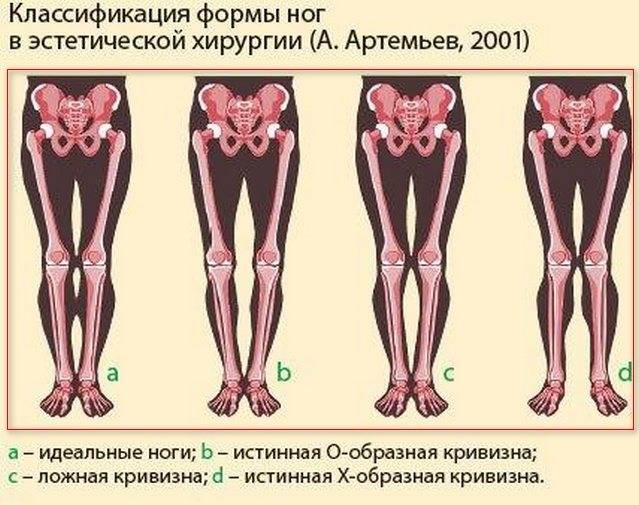 Ноги колесом (кривые) у девушки. как исправить