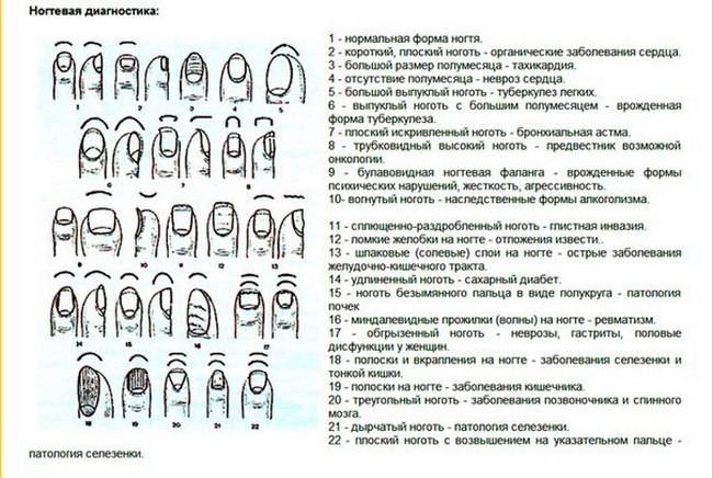 Как определить болезнь по ногтям