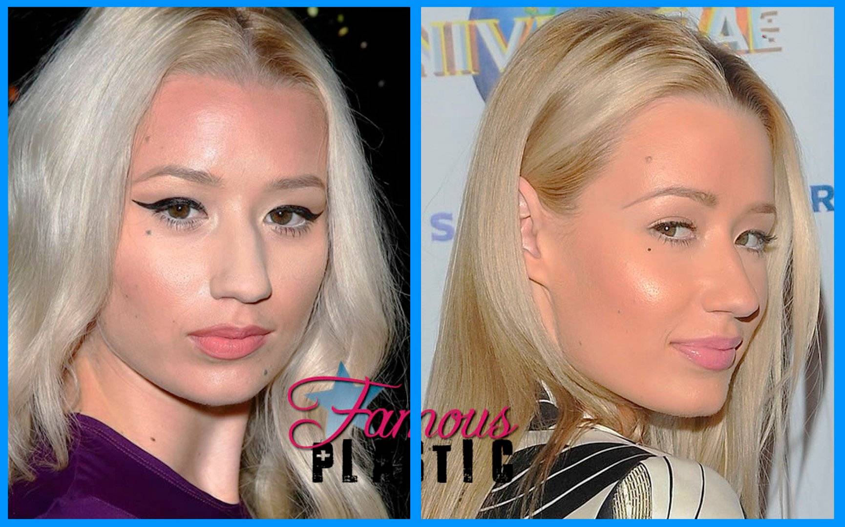 Iggy azalea plastic surgery explained! (before & after 2021)