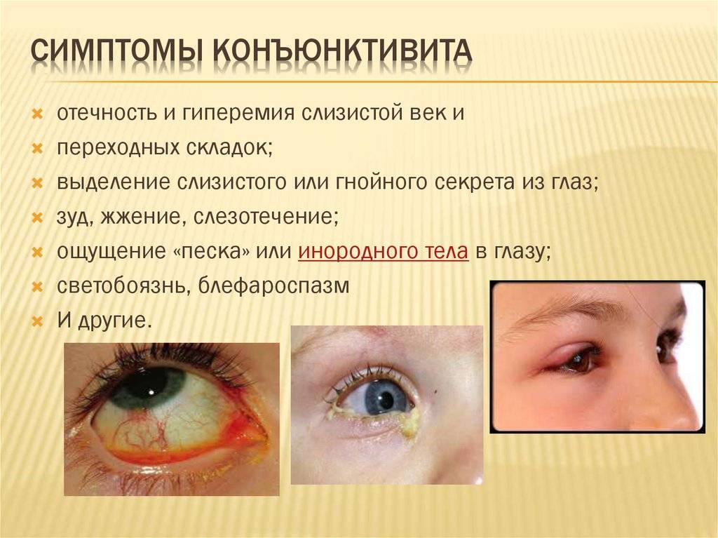 У ребенка гноятся глаза: 3 вероятных причины-заболевания, методы лечения и профилактика
