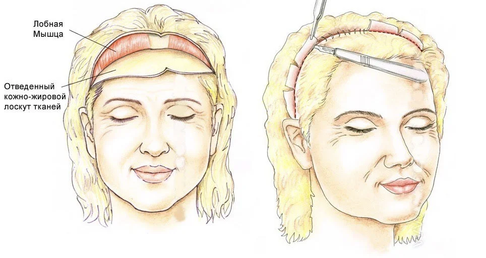 Эндоскопическая подтяжка бровей и лба с помощью устройства endotine forehead