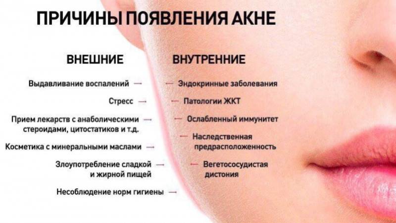 Прыщи на щеках у женщин: гормональные причины | романов георгий никитич