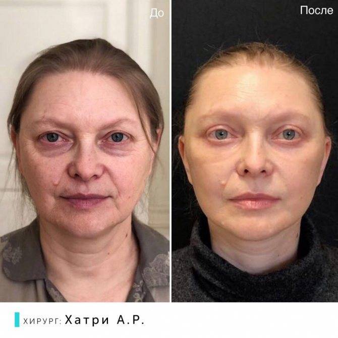 Подтяжка лица