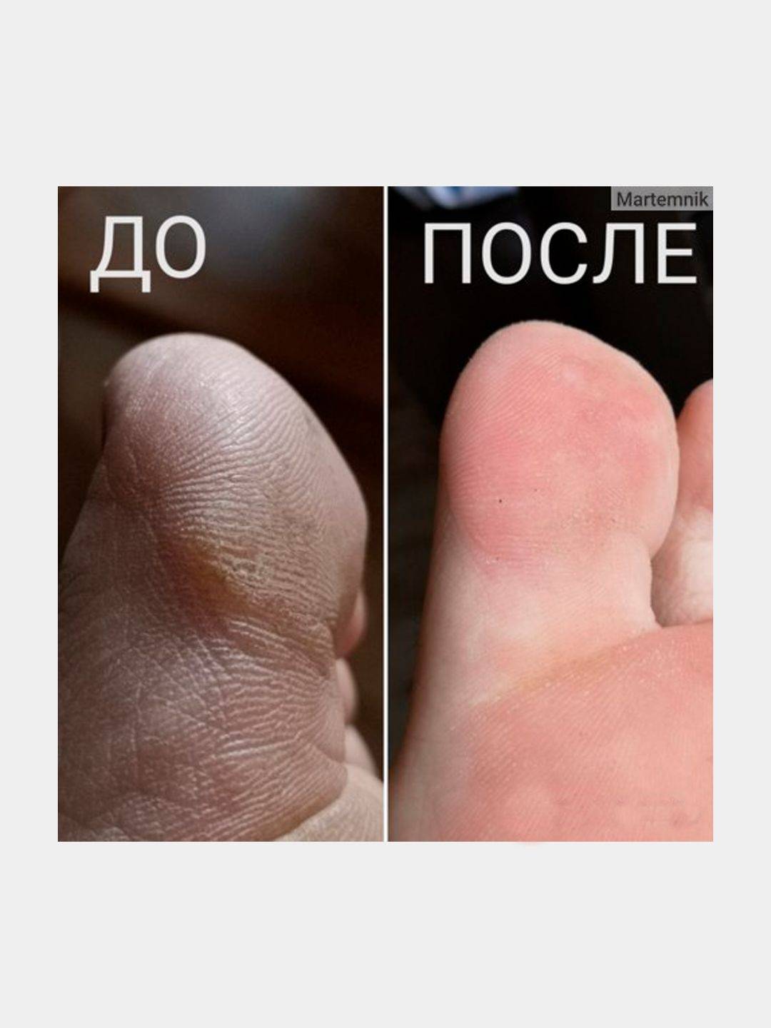 Как пользоваться «жидким лезвием» для педикюра