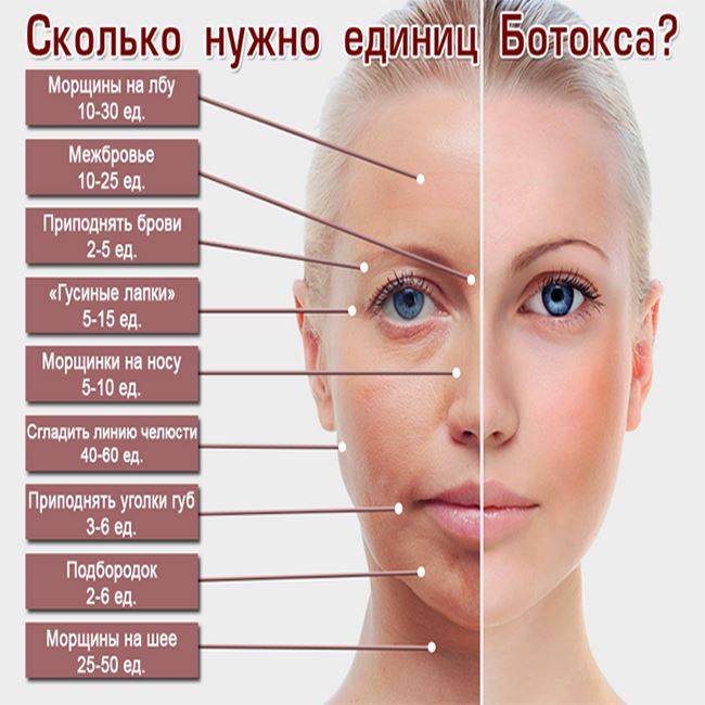 Особенности процедуры введения ботокса под глаза